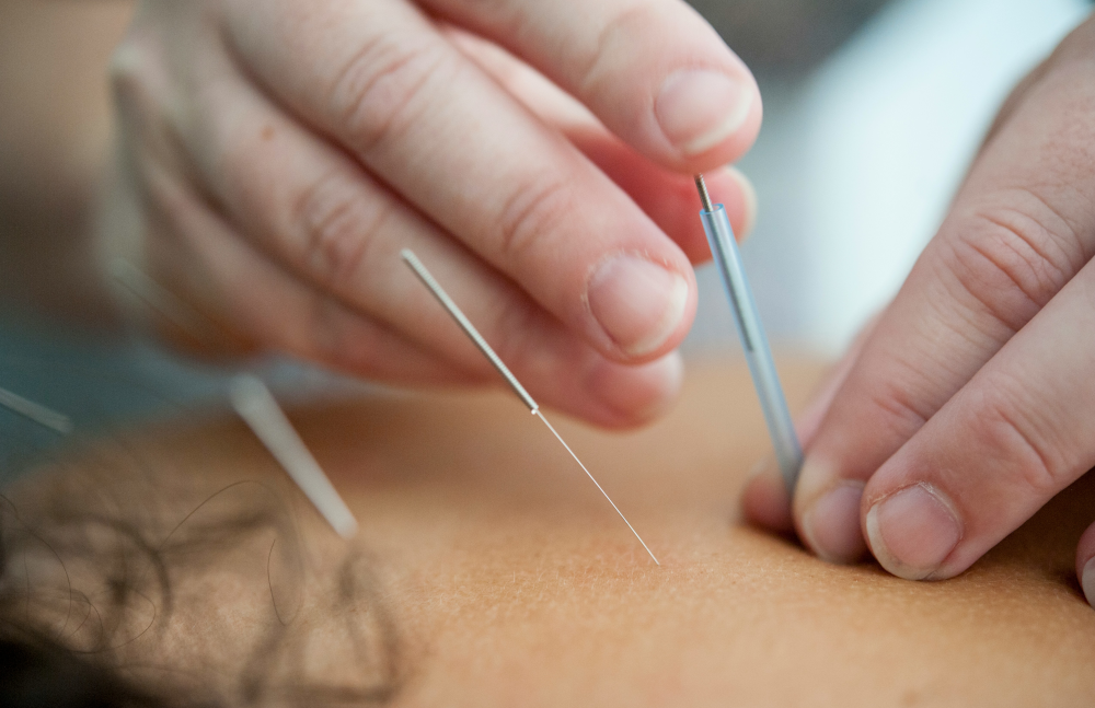 Triggerpunkttherapie Akupunktur Triggerpunkttherapie Akupunktur Rücken