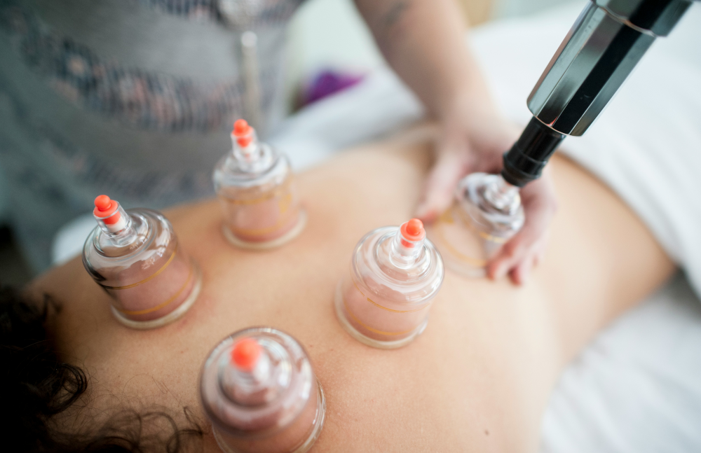 Triggerpunkttherapie Schröpfmassage Triggerpunkttherapie Physiotherapie Schröpfmassage mit Schröpfköpfen auf dem Rücken